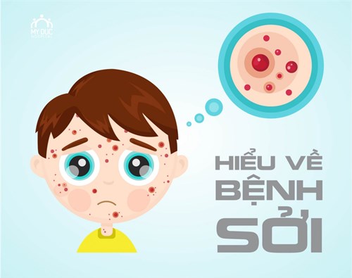 Nguyên nhân mắc bệnh  Sởi  - Biện pháp phòng ngừa hiện nay.